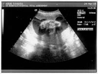 Baby's Foot